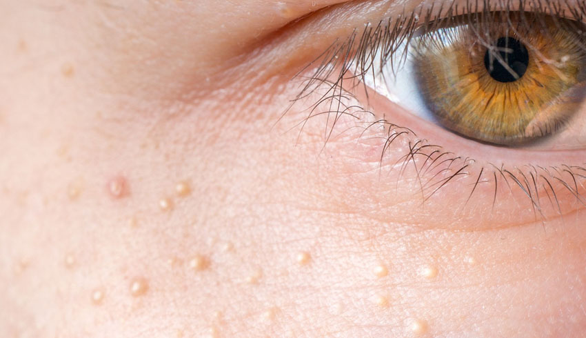 How To Get Rid of Milia Around the Eyes